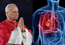 León XIV será internado mañana para su operación por un nódulo pulmonar